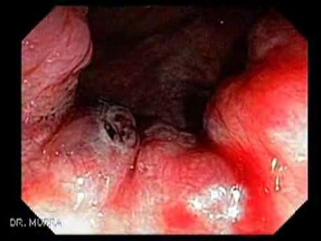 Ulcerated Internal Hemorrhoid (1 of 4)