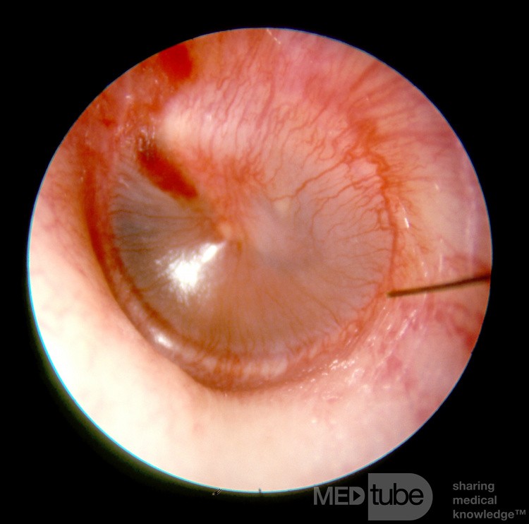 Early Acute Otitis Media: Stage of Redness