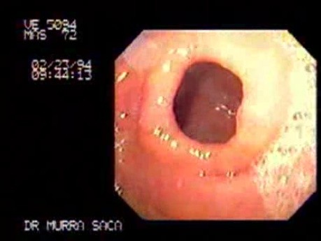 Gastric Antral Band