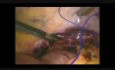 Traumatic Diaphragmatic Hernia - Laparoscopic Repair