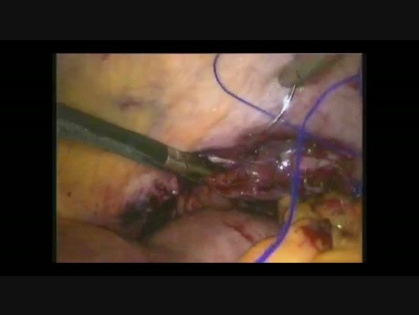 Traumatic Diaphragmatic Hernia - Laparoscopic Repair