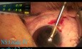 Quick Phacoemulsification 3