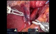 Robotic Fundoplication with Mesh
