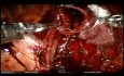 Tracheal Chondrosarcoma Operated by Robotic Surgery and ECMO Assistance