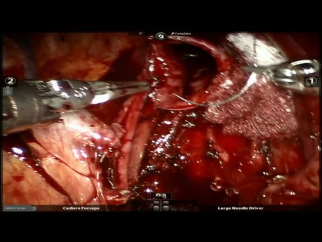 Tracheal Chondrosarcoma Operated by Robotic Surgery and ECMO Assistance