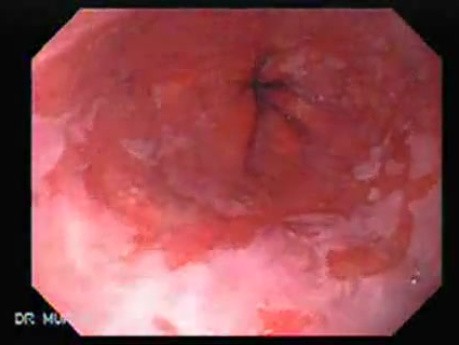Barrett's Esophagus of long segment (10 of 11)