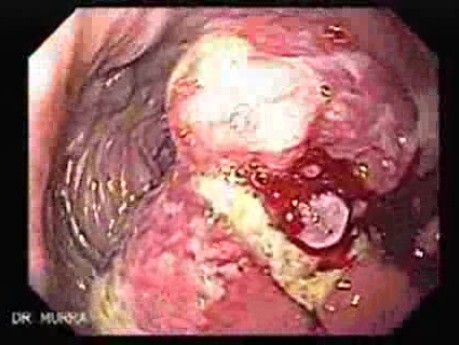 Recurrent Gastric Adenocarcinoma - Endoscopy (2 of 4)