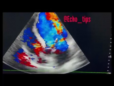 2. Echocardiography - What You See?