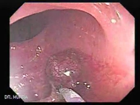 Endoscopic Appearance of Pedicled Polyp of the Descending Colon (6 of 7)