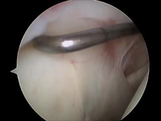 Shoulder Arthroscopy - Inspection With Usage Of A Hook