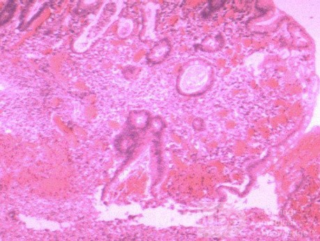 Multiple Rectal Ulcers (109 of 110)