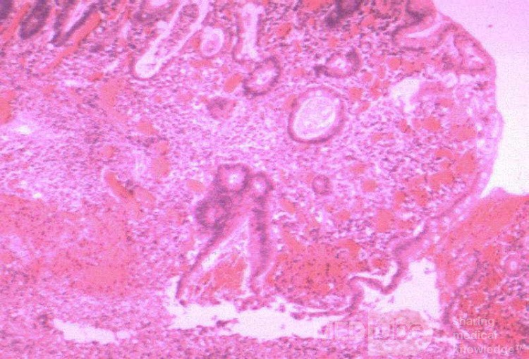 Multiple Rectal Ulcers (109 of 110)