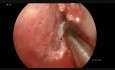 Endoscopic Septoplasty, Turbinoplasty and Unilateral Sinusitis Treatment