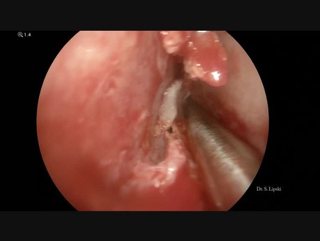 Endoscopic Septoplasty, Turbinoplasty and Unilateral Sinusitis Treatment