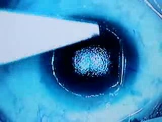 Myopia Surgery - Lasik Enhancement After 10 Years