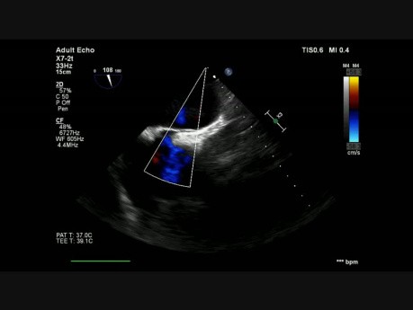 Patent Foramen Ovale with Left to Right Shunt