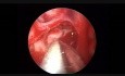 Endoscopic Optic Nerve Sheath Fenestration