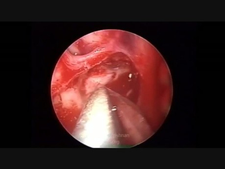 Endoscopic Optic Nerve Sheath Fenestration
