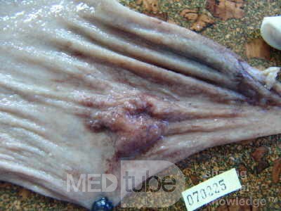 Early Gastric Cancer (16 of 21)