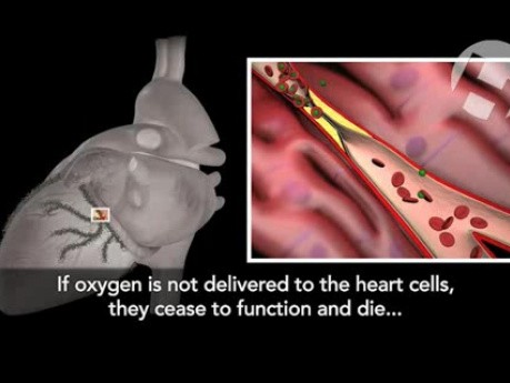Myocardial Infarction with Hemopericardial Tamponade