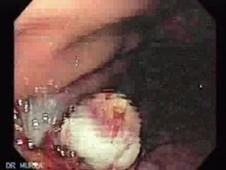 Bleeding Due to Dieulafoy´s Lesion ( of 8)