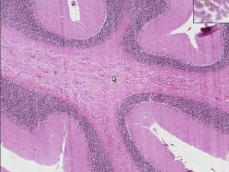 Adrenoleukodystrophy