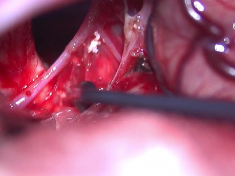 Giant Craniopharyngioma Resection