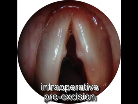 Vocal Folds Nodules - Microsurgery