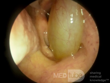 Typical Large Polyp Entering the Left Choana