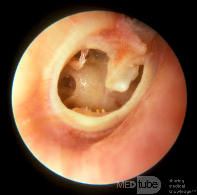 Tympanic Membrane Perforation With Atrophic Long Process Incus