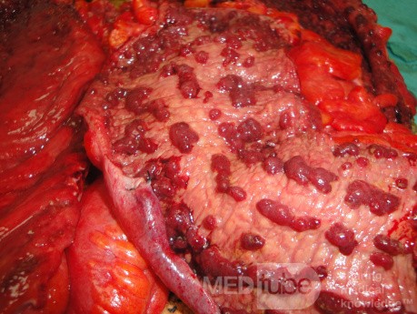 Multiple Rectal Ulcers (84 of 110)