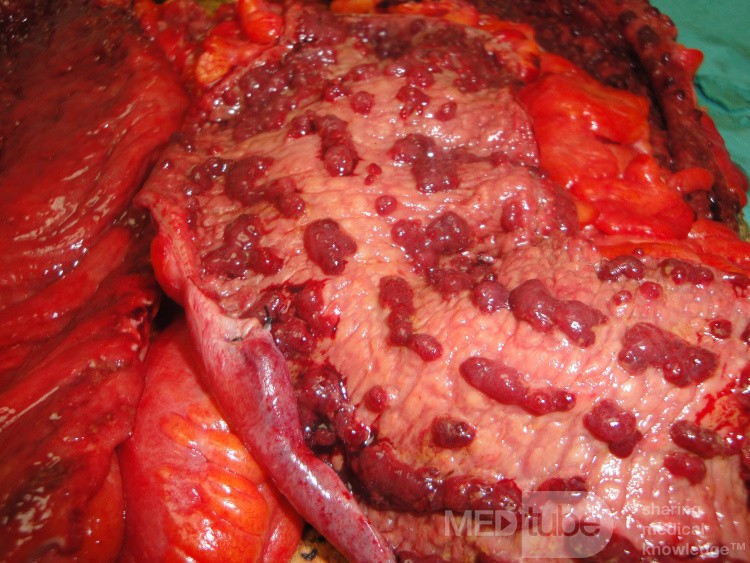 Multiple Rectal Ulcers (84 of 110)