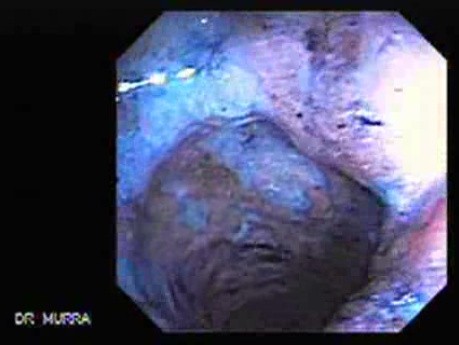 Endoscopy Of Ulcerative Colitis (3 of 3)