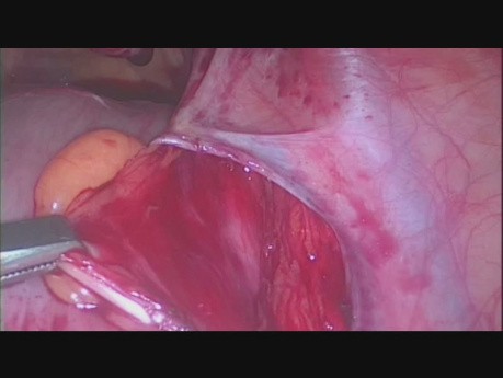 Retroperitoneal Right Ureter Identification