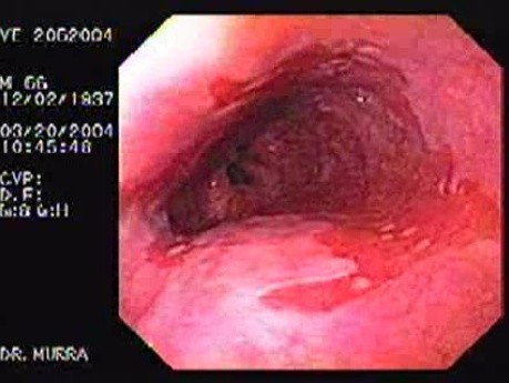 Barrett's Esophagus of long segment (1 of 24)