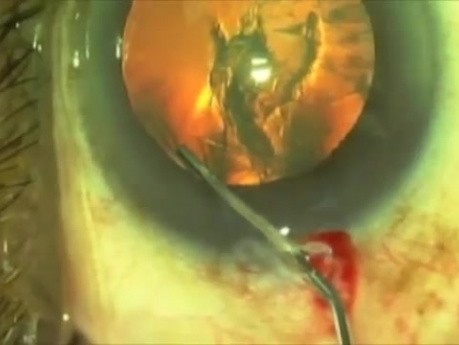 Plasma Ablation Capsulotomy - Fugo Blade Or Femtosecond Laser?