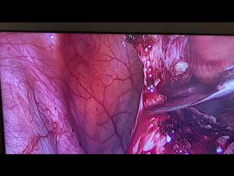 Left Endometrioma Excision