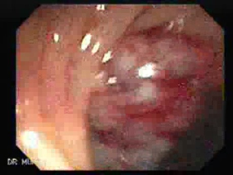 Adenocarcinoma - Cecum (3 of 4)