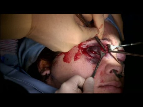 Multiple Facial Fractures Treatment
