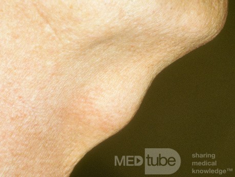 Thyroglossal Duct Cyst