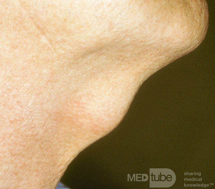 Thyroglossal Duct Cyst