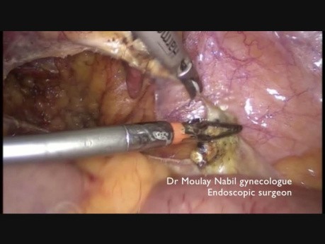 Total Hysterectomy in Obese Patient