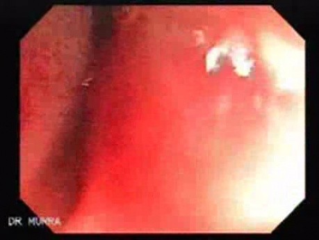 Colitis Ulcerosa - Pseudopolyps (17 of 22)