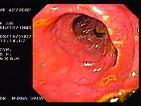 Multiple Duodenal Ulcers (1 of 3)