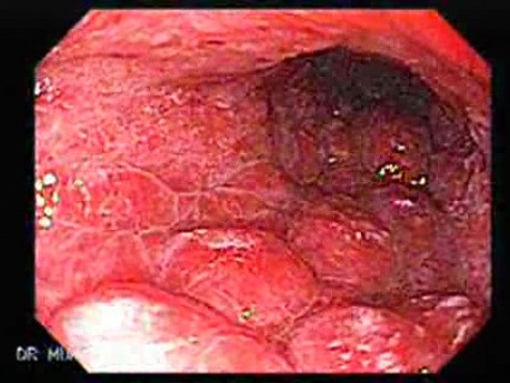 Scirrhous Gastric Carcinoma - Endoscopy (1 of 15)