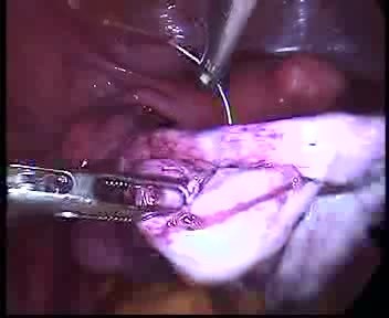 Laparoscopic Treatment Of Big Ovarian Endometriosis Cyst