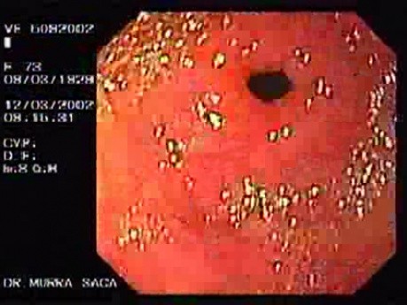 Chronic Gastritis With Intestinal Metaplasia Of The Pre - Pyloric Antrum (1 of 3)