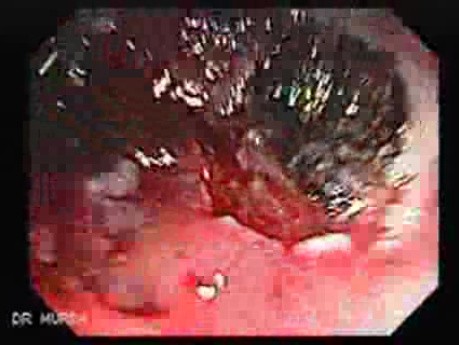 Tubulo - Villous Rectal Adenoma - Endoscopy (18 of 35)
