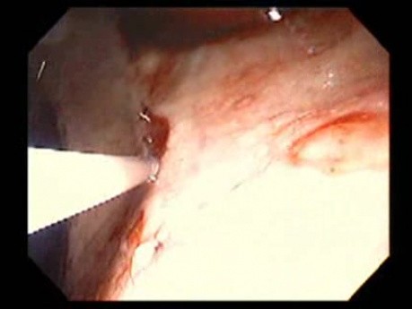 Bleeding Due to Dieulafoy´s Lesion (7 of 8)