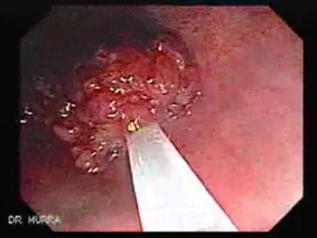Endoscopic Resection of Giant Tubulo-Villous of the rectum (9 of 35)